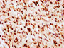 IHC image of CAC15487 diluted at 1:10 and staining in paraffin-embedded human glioma performed on a Leica BondTM system. After dewaxing and hydration, antigen retrieval was mediated by high pressure in a citrate buffer (pH 6.0). Section was blocked with 10% normal goat serum 30min at RT. Then primary antibody (1% BSA) was incubated at 4°C overnight. The primary is detected by a biotinylated secondary antibody and visualized using an HRP conjugated SP system. IHC image of CAC15487 diluted at 1:10 and staining in paraffin-embedded human glioma performed on a Leica BondTM system. After dewaxing and hydration, antigen retrieval was mediated by high pressure in a citrate buffer (pH 6.0). Section was blocked with 10% normal goat serum 30min at RT. Then primary antibody (1% BSA) was incubated at 4°C overnight. The primary is detected by a biotinylated secondary antibody and visualized using an HRP conjugated SP system.