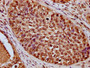 IHC image of CAC15492 diluted at 1:20 and staining in paraffin-embedded human cervical cancer performed on a Leica BondTM system. After dewaxing and hydration, antigen retrieval was mediated by high pressure in a citrate buffer (pH 6.0). Section was blocked with 10% normal goat serum 30min at RT. Then primary antibody (1% BSA) was incubated at 4°C overnight. The primary is detected by a biotinylated secondary antibody and visualized using an HRP conjugated SP system.