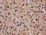 IHC image of CAC15497 diluted at 1:20 and staining in paraffin-embedded human glioma performed on a Leica BondTM system. After dewaxing and hydration, antigen retrieval was mediated by high pressure in a citrate buffer (pH 6.0). Section was blocked with 10% normal goat serum 30min at RT. Then primary antibody (1% BSA) was incubated at 4°C overnight. The primary is detected by a biotinylated secondary antibody and visualized using an HRP conjugated SP system.
