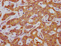 IHC image of CAC15513 diluted at 1:500 and staining in paraffin-embedded human liver cancer performed on a Leica BondTM system. After dewaxing and hydration, antigen retrieval was mediated by high pressure in a citrate buffer (pH 6.0). Section was blocked with 10% normal goat serum 30min at RT. Then primary antibody (1% BSA) was incubated at 4°C overnight. The primary is detected by a biotinylated secondary antibody and visualized using an HRP conjugated SP system.