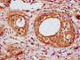 IHC image of CAC15516 diluted at 1:200 and staining in paraffin-embedded human cervical cancer performed on a Leica BondTM system. After dewaxing and hydration, antigen retrieval was mediated by high pressure in a citrate buffer (pH 6.0). Section was blocked with 10% normal goat serum 30min at RT. Then primary antibody (1% BSA) was incubated at 4°C overnight. The primary is detected by a biotinylated secondary antibody and visualized using an HRP conjugated SP system.