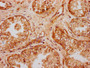 IHC image of CAC15528 diluted at 1:300 and staining in paraffin-embedded human prostate cancer performed on a Leica BondTM system. After dewaxing and hydration, antigen retrieval was mediated by high pressure in a citrate buffer (pH 6.0). Section was blocked with 10% normal goat serum 30min at RT. Then primary antibody (1% BSA) was incubated at 4°C overnight. The primary is detected by a biotinylated secondary antibody and visualized using an HRP conjugated SP system.