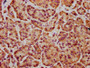 IHC image of CAC15533 diluted at 1:400 and staining in paraffin-embedded human pancreatic cancer performed on a Leica BondTM system. After dewaxing and hydration, antigen retrieval was mediated by high pressure in a citrate buffer (pH 6.0). Section was blocked with 10% normal goat serum 30min at RT. Then primary antibody (1% BSA) was incubated at 4°C overnight. The primary is detected by a biotinylated secondary antibody and visualized using an HRP conjugated SP system.