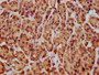 IHC image of CAC15540 diluted at 1:300 and staining in paraffin-embedded human pancreatic cancer performed on a Leica BondTM system. After dewaxing and hydration, antigen retrieval was mediated by high pressure in a citrate buffer (pH 6.0). Section was blocked with 10% normal goat serum 30min at RT. Then primary antibody (1% BSA) was incubated at 4°C overnight. The primary is detected by a biotinylated secondary antibody and visualized using an HRP conjugated SP system.