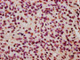 IHC image of CAC15552 diluted at 1:20 and staining in paraffin-embedded human glioma performed on a Leica BondTM system. After dewaxing and hydration, antigen retrieval was mediated by high pressure in a citrate buffer (pH 6.0). Section was blocked with 10% normal goat serum 30min at RT. Then primary antibody (1% BSA) was incubated at 4°C overnight. The primary is detected by a biotinylated secondary antibody and visualized using an HRP conjugated SP system.