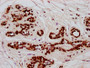 IHC image of CAC15553 diluted at 1:10 and staining in paraffin-embedded human breast cancer performed on a Leica BondTM system. After dewaxing and hydration, antigen retrieval was mediated by high pressure in a citrate buffer (pH 6.0). Section was blocked with 10% normal goat serum 30min at RT. Then primary antibody (1% BSA) was incubated at 4°C overnight. The primary is detected by a biotinylated secondary antibody and visualized using an HRP conjugated SP system.