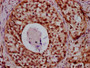 IHC image of CAC15560 diluted at 1:20 and staining in paraffin-embedded human cervical cancer performed on a Leica BondTM system. After dewaxing and hydration, antigen retrieval was mediated by high pressure in a citrate buffer (pH 6.0). Section was blocked with 10% normal goat serum 30min at RT. Then primary antibody (1% BSA) was incubated at 4°C overnight. The primary is detected by a biotinylated secondary antibody and visualized using an HRP conjugated SP system.