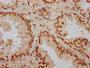 IHC image of CAC15571 diluted at 1:20 and staining in paraffin-embedded human prostate cancer performed on a Leica BondTM system. After dewaxing and hydration, antigen retrieval was mediated by high pressure in a citrate buffer (pH 6.0). Section was blocked with 10% normal goat serum 30min at RT. Then primary antibody (1% BSA) was incubated at 4°C overnight. The primary is detected by a biotinylated secondary antibody and visualized using an HRP conjugated SP system.