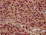 IHC image of CAC15587 diluted at 1:8 and staining in paraffin-embedded human glioma performed on a Leica BondTM system. After dewaxing and hydration, antigen retrieval was mediated by high pressure in a citrate buffer (pH 6.0). Section was blocked with 10% normal goat serum 30min at RT. Then primary antibody (1% BSA) was incubated at 4°C overnight. The primary is detected by a biotinylated secondary antibody and visualized using an HRP conjugated SP system.