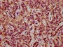 IHC image of CAC15592 diluted at 1:10 and staining in paraffin-embedded human liver cancer performed on a Leica BondTM system. After dewaxing and hydration, antigen retrieval was mediated by high pressure in a citrate buffer (pH 6.0). Section was blocked with 10% normal goat serum 30min at RT. Then primary antibody (1% BSA) was incubated at 4°C overnight. The primary is detected by a biotinylated secondary antibody and visualized using an HRP conjugated SP system.