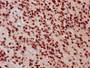 IHC image of CAC15594 diluted at 1:10 and staining in paraffin-embedded human glioma performed on a Leica BondTM system. After dewaxing and hydration, antigen retrieval was mediated by high pressure in a citrate buffer (pH 6.0). Section was blocked with 10% normal goat serum 30min at RT. Then primary antibody (1% BSA) was incubated at 4°C overnight. The primary is detected by a biotinylated secondary antibody and visualized using an HRP conjugated SP system.