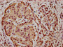 IHC image of CAC15595 diluted at 1:5 and staining in paraffin-embedded human pancreatic cancer performed on a Leica BondTM system. After dewaxing and hydration, antigen retrieval was mediated by high pressure in a citrate buffer (pH 6.0). Section was blocked with 10% normal goat serum 30min at RT. Then primary antibody (1% BSA) was incubated at 4°C overnight. The primary is detected by a biotinylated secondary antibody and visualized using an HRP conjugated SP system.