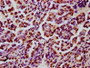 IHC image of CAC15601 diluted at 1:5 and staining in paraffin-embedded human lung cancer performed on a Leica BondTM system. After dewaxing and hydration, antigen retrieval was mediated by high pressure in a citrate buffer (pH 6.0). Section was blocked with 10% normal goat serum 30min at RT. Then primary antibody (1% BSA) was incubated at 4°C overnight. The primary is detected by a biotinylated secondary antibody and visualized using an HRP conjugated SP system.