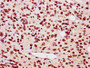 IHC image of CAC15601 diluted at 1:5 and staining in paraffin-embedded human glioma performed on a Leica BondTM system. After dewaxing and hydration, antigen retrieval was mediated by high pressure in a citrate buffer (pH 6.0). Section was blocked with 10% normal goat serum 30min at RT. Then primary antibody (1% BSA) was incubated at 4°C overnight. The primary is detected by a biotinylated secondary antibody and visualized using an HRP conjugated SP system.