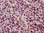 IHC image of CAC15609 diluted at 1:15 and staining in paraffin-embedded human glioma performed on a Leica BondTM system. After dewaxing and hydration, antigen retrieval was mediated by high pressure in a citrate buffer (pH 6.0). Section was blocked with 10% normal goat serum 30min at RT. Then primary antibody (1% BSA) was incubated at 4°C overnight. The primary is detected by a biotinylated secondary antibody and visualized using an HRP conjugated SP system.