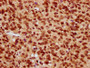 IHC image of CAC15634 diluted at 1:20 and staining in paraffin-embedded human glioma performed on a Leica BondTM system. After dewaxing and hydration, antigen retrieval was mediated by high pressure in a citrate buffer (pH 6.0). Section was blocked with 10% normal goat serum 30min at RT. Then primary antibody (1% BSA) was incubated at 4°C overnight. The primary is detected by a biotinylated secondary antibody and visualized using an HRP conjugated SP system.