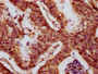 IHC image of CAC15636 diluted at 1:10 and staining in paraffin-embedded human colon cancer performed on a Leica BondTM system. After dewaxing and hydration, antigen retrieval was mediated by high pressure in a citrate buffer (pH 6.0). Section was blocked with 10% normal goat serum 30min at RT. Then primary antibody (1% BSA) was incubated at 4°C overnight. The primary is detected by a biotinylated secondary antibody and visualized using an HRP conjugated SP system.