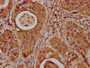 IHC image of CAC15638 diluted at 1:20 and staining in paraffin-embedded human cervical cancer performed on a Leica BondTM system. After dewaxing and hydration, antigen retrieval was mediated by high pressure in a citrate buffer (pH 6.0). Section was blocked with 10% normal goat serum 30min at RT. Then primary antibody (1% BSA) was incubated at 4°C overnight. The primary is detected by a biotinylated secondary antibody and visualized using an HRP conjugated SP system.