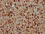 IHC image of CAC15641 diluted at 1:20 and staining in paraffin-embedded human glioma performed on a Leica BondTM system. After dewaxing and hydration, antigen retrieval was mediated by high pressure in a citrate buffer (pH 6.0). Section was blocked with 10% normal goat serum 30min at RT. Then primary antibody (1% BSA) was incubated at 4°C overnight. The primary is detected by a biotinylated secondary antibody and visualized using an HRP conjugated SP system.