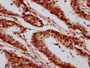IHC image of CAC15646 diluted at 1:20 and staining in paraffin-embedded human colon cancer performed on a Leica BondTM system. After dewaxing and hydration, antigen retrieval was mediated by high pressure in a citrate buffer (pH 6.0). Section was blocked with 10% normal goat serum 30min at RT. Then primary antibody (1% BSA) was incubated at 4°C overnight. The primary is detected by a biotinylated secondary antibody and visualized using an HRP conjugated SP system.