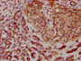 IHC image of CAC15660 diluted at 1:200 and staining in paraffin-embedded human pancreatic cancer performed on a Leica BondTM system. After dewaxing and hydration, antigen retrieval was mediated by high pressure in a citrate buffer (pH 6.0). Section was blocked with 10% normal goat serum 30min at RT. Then primary antibody (1% BSA) was incubated at 4°C overnight. The primary is detected by a biotinylated secondary antibody and visualized using an HRP conjugated SP system.