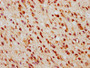 IHC image of CAC15664 diluted at 1:500 and staining in paraffin-embedded human glioma performed on a Leica BondTM system. After dewaxing and hydration, antigen retrieval was mediated by high pressure in a citrate buffer (pH 6.0). Section was blocked with 10% normal goat serum 30min at RT. Then primary antibody (1% BSA) was incubated at 4°C overnight. The primary is detected by a biotinylated secondary antibody and visualized using an HRP conjugated SP system.