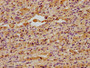 IHC image of CAC15730 diluted at 1:400 and staining in paraffin-embedded human lung cancer performed on a Leica BondTM system. After dewaxing and hydration, antigen retrieval was mediated by high pressure in a citrate buffer (pH 6.0). Section was blocked with 10% normal goat serum 30min at RT. Then primary antibody (1% BSA) was incubated at 4°C overnight. The primary is detected by a biotinylated secondary antibody and visualized using an HRP conjugated SP system.