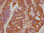 IHC image of CAC15741 diluted at 1:500 and staining in paraffin-embedded human colon cancer performed on a Leica BondTM system. After dewaxing and hydration, antigen retrieval was mediated by high pressure in a citrate buffer (pH 6.0). Section was blocked with 10% normal goat serum 30min at RT. Then primary antibody (1% BSA) was incubated at 4°C overnight. The primary is detected by a biotinylated secondary antibody and visualized using an HRP conjugated SP system.