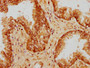 IHC image of CAC15742 diluted at 1:200 and staining in paraffin-embedded human prostate cancer performed on a Leica BondTM system. After dewaxing and hydration, antigen retrieval was mediated by high pressure in a citrate buffer (pH 6.0). Section was blocked with 10% normal goat serum 30min at RT. Then primary antibody (1% BSA) was incubated at 4°C overnight. The primary is detected by a biotinylated secondary antibody and visualized using an HRP conjugated SP system.