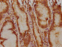 IHC image of CAC15745 diluted at 1:400 and staining in paraffin-embedded human gastric cancer performed on a Leica BondTM system. After dewaxing and hydration, antigen retrieval was mediated by high pressure in a citrate buffer (pH 6.0). Section was blocked with 10% normal goat serum 30min at RT. Then primary antibody (1% BSA) was incubated at 4°C overnight. The primary is detected by a biotinylated secondary antibody and visualized using an HRP conjugated SP system.