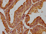 IHC image of CAC15756 diluted at 1:200 and staining in paraffin-embedded human endometrial cancer performed on a Leica BondTM system. After dewaxing and hydration, antigen retrieval was mediated by high pressure in a citrate buffer (pH 6.0). Section was blocked with 10% normal goat serum 30min at RT. Then primary antibody (1% BSA) was incubated at 4°C overnight. The primary is detected by a biotinylated secondary antibody and visualized using an HRP conjugated SP system.