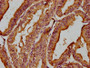 IHC image of CAC15759 diluted at 1:200 and staining in paraffin-embedded human endometrial cancer performed on a Leica BondTM system. After dewaxing and hydration, antigen retrieval was mediated by high pressure in a citrate buffer (pH 6.0). Section was blocked with 10% normal goat serum 30min at RT. Then primary antibody (1% BSA) was incubated at 4°C overnight. The primary is detected by a biotinylated secondary antibody and visualized using an HRP conjugated SP system.
