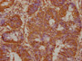 IHC image of CAC15765 diluted at 1:100 and staining in paraffin-embedded human colon cancer performed on a Leica BondTM system. After dewaxing and hydration, antigen retrieval was mediated by high pressure in a citrate buffer (pH 6.0). Section was blocked with 10% normal goat serum 30min at RT. Then primary antibody (1% BSA) was incubated at 4°C overnight. The primary is detected by a biotinylated secondary antibody and visualized using an HRP conjugated SP system.