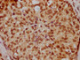 IHC image of CAC15780 diluted at 1:200 and staining in paraffin-embedded human breast cancer performed on a Leica BondTM system. After dewaxing and hydration, antigen retrieval was mediated by high pressure in a citrate buffer (pH 6.0). Section was blocked with 10% normal goat serum 30min at RT. Then primary antibody (1% BSA) was incubated at 4°C overnight. The primary is detected by a biotinylated secondary antibody and visualized using an HRP conjugated SP system.