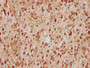 IHC image of CAC15785 diluted at 1:100 and staining in paraffin-embedded human glioma cancer performed on a Leica BondTM system. After dewaxing and hydration, antigen retrieval was mediated by high pressure in a citrate buffer (pH 6.0). Section was blocked with 10% normal goat serum 30min at RT. Then primary antibody (1% BSA) was incubated at 4°C overnight. The primary is detected by a biotinylated secondary antibody and visualized using an HRP conjugated SP system.