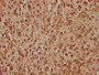 IHC image of CAC15788 diluted at 1:400 and staining in paraffin-embedded human glioma performed on a Leica BondTM system. After dewaxing and hydration, antigen retrieval was mediated by high pressure in a citrate buffer (pH 6.0). Section was blocked with 10% normal goat serum 30min at RT. Then primary antibody (1% BSA) was incubated at 4°C overnight. The primary is detected by a biotinylated secondary antibody and visualized using an HRP conjugated SP system.