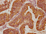 IHC image of CAC15794 diluted at 1:100 and staining in paraffin-embedded human endometrial cancer performed on a Leica BondTM system. After dewaxing and hydration, antigen retrieval was mediated by high pressure in a citrate buffer (pH 6.0). Section was blocked with 10% normal goat serum 30min at RT. Then primary antibody (1% BSA) was incubated at 4°C overnight. The primary is detected by a biotinylated secondary antibody and visualized using an HRP conjugated SP system. IHC image of CAC15794 diluted at 1:100 and staining in paraffin-embedded human endometrial cancer performed on a Leica BondTM system. After dewaxing and hydration, antigen retrieval was mediated by high pressure in a citrate buffer (pH 6.0). Section was blocked with 10% normal goat serum 30min at RT. Then primary antibody (1% BSA) was incubated at 4°C overnight. The primary is detected by a biotinylated secondary antibody and visualized using an HRP conjugated SP system.