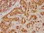 IHC image of CAC15795 diluted at 1:100 and staining in paraffin-embedded human liver cancer performed on a Leica BondTM system. After dewaxing and hydration, antigen retrieval was mediated by high pressure in a citrate buffer (pH 6.0). Section was blocked with 10% normal goat serum 30min at RT. Then primary antibody (1% BSA) was incubated at 4°C overnight. The primary is detected by a biotinylated secondary antibody and visualized using an HRP conjugated SP system.