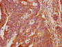 IHC image of CAC15803 diluted at 1:100 and staining in paraffin-embedded human colon cancer performed on a Leica BondTM system. After dewaxing and hydration, antigen retrieval was mediated by high pressure in a citrate buffer (pH 6.0). Section was blocked with 10% normal goat serum 30min at RT. Then primary antibody (1% BSA) was incubated at 4°C overnight. The primary is detected by a biotinylated secondary antibody and visualized using an HRP conjugated SP system.