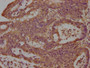 IHC image of CAC15813 diluted at 1:100 and staining in paraffin-embedded human colon cancer performed on a Leica BondTM system. After dewaxing and hydration, antigen retrieval was mediated by high pressure in a citrate buffer (pH 6.0). Section was blocked with 10% normal goat serum 30min at RT. Then primary antibody (1% BSA) was incubated at 4°C overnight. The primary is detected by a biotinylated secondary antibody and visualized using an HRP conjugated SP system.