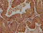 IHC image of CAC15823 diluted at 1:100 and staining in paraffin-embedded human endometrial cancer performed on a Leica BondTM system. After dewaxing and hydration, antigen retrieval was mediated by high pressure in a citrate buffer (pH 6.0). Section was blocked with 10% normal goat serum 30min at RT. Then primary antibody (1% BSA) was incubated at 4°C overnight. The primary is detected by a biotinylated secondary antibody and visualized using an HRP conjugated SP system.