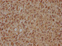 IHC image of CAC15833 diluted at 1:100 and staining in paraffin-embedded human glioma cancer performed on a Leica BondTM system. After dewaxing and hydration, antigen retrieval was mediated by high pressure in a citrate buffer (pH 6.0). Section was blocked with 10% normal goat serum 30min at RT. Then primary antibody (1% BSA) was incubated at 4°C overnight. The primary is detected by a biotinylated secondary antibody and visualized using an HRP conjugated SP system.