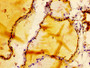 IHC image diluted at 1:100 and staining in paraffin-embedded human thyroid tissue performed on a Leica BondTM system. After dewaxing and hydration, antigen retrieval was mediated by high pressure in a citrate buffer (pH 6.0). Section was blocked with 10% normal goat serum 30min at RT. Then primary antibody (1% BSA) was incubated at 4°C overnight. The primary is detected by a biotinylated secondary antibody and visualized using an HRP conjugated SP system. IHC image diluted at 1:100 and staining in paraffin-embedded human thyroid tissue performed on a Leica BondTM system. After dewaxing and hydration, antigen retrieval was mediated by high pressure in a citrate buffer (pH 6.0). Section was blocked with 10% normal goat serum 30min at RT. Then primary antibody (1% BSA) was incubated at 4°C overnight. The primary is detected by a biotinylated secondary antibody and visualized using an HRP conjugated SP system.