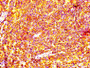 IHC image diluted at 1:100 and staining in paraffin-embedded human lymph node tissue performed on a Leica BondTM system. After dewaxing and hydration, antigen retrieval was mediated by high pressure in a citrate buffer (pH 6.0). Section was blocked with 10% normal goat serum 30min at RT. Then primary antibody (1% BSA) was incubated at 4°C overnight. The primary is detected by a biotinylated secondary antibody and visualized using an HRP conjugated SP system. IHC image diluted at 1:100 and staining in paraffin-embedded human lymph node tissue performed on a Leica BondTM system. After dewaxing and hydration, antigen retrieval was mediated by high pressure in a citrate buffer (pH 6.0). Section was blocked with 10% normal goat serum 30min at RT. Then primary antibody (1% BSA) was incubated at 4°C overnight. The primary is detected by a biotinylated secondary antibody and visualized using an HRP conjugated SP system.