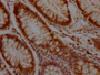 IHC image diluted at 1:100 and staining in paraffin-embedded human colon cancer performed on a Leica BondTM system. After dewaxing and hydration, antigen retrieval was mediated by high pressure in a citrate buffer (pH 6.0). Section was blocked with 10% normal goat serum 30min at RT. Then primary antibody (1% BSA) was incubated at 4? overnight. The primary is detected by a Goat anti-rabbit IgG polymer labeled by HRP and visualized using 0.05% DAB. IHC image diluted at 1:100 and staining in paraffin-embedded human colon cancer performed on a Leica BondTM system. After dewaxing and hydration, antigen retrieval was mediated by high pressure in a citrate buffer (pH 6.0). Section was blocked with 10% normal goat serum 30min at RT. Then primary antibody (1% BSA) was incubated at 4? overnight. The primary is detected by a Goat anti-rabbit IgG polymer labeled by HRP and visualized using 0.05% DAB.