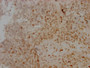 IHC image of RAC07169 diluted at 1:100 and staining in paraffin-embedded human cervical cancer performed on a Leica BondTM system. After dewaxing and hydration, antigen retrieval was mediated by high pressure in a citrate buffer (pH 6.0). Section was blocked with 10% normal goat serum 30min at RT. Then primary antibody (1% BSA) was incubated at 4? overnight. The primary is detected by a Goat anti-rabbit IgG polymer labeled by HRP and visualized using 0.05% DAB. IHC image of RAC07169 diluted at 1:100 and staining in paraffin-embedded human cervical cancer performed on a Leica BondTM system. After dewaxing and hydration, antigen retrieval was mediated by high pressure in a citrate buffer (pH 6.0). Section was blocked with 10% normal goat serum 30min at RT. Then primary antibody (1% BSA) was incubated at 4? overnight. The primary is detected by a Goat anti-rabbit IgG polymer labeled by HRP and visualized using 0.05% DAB.