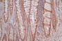 IHC image of RAC07175 diluted at 1:50 and staining in paraffin-embedded human rectal cancer performed on a Leica BondTM system. After dewaxing and hydration, antigen retrieval was mediated by high pressure in a citrate buffer (pH 6.0). Section was blocked with 10% normal goat serum 30min at RT. Then primary antibody (1% BSA) was incubated at 4°C overnight. The primary is detected by a Goat anti-rabbit polymer IgG labeled by HRP and visualized using 0.53% DAB. IHC image of RAC07175 diluted at 1:50 and staining in paraffin-embedded human rectal cancer performed on a Leica BondTM system. After dewaxing and hydration, antigen retrieval was mediated by high pressure in a citrate buffer (pH 6.0). Section was blocked with 10% normal goat serum 30min at RT. Then primary antibody (1% BSA) was incubated at 4°C overnight. The primary is detected by a Goat anti-rabbit polymer IgG labeled by HRP and visualized using 0.53% DAB.