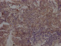 IHC image of RAC07184 diluted at 1:100 and staining in paraffin-embedded human lung cancer performed on a Leica BondTM system. After dewaxing and hydration, antigen retrieval was mediated by high pressure in a citrate buffer (pH 6.0). Section was blocked with 10% normal goat serum 30min at RT. Then primary antibody (1% BSA) was incubated at 4? overnight. The primary is detected by a Goat anti-rabbit IgG polymer labeled by HRP and visualized using 0.05% DAB.