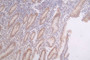 IHC image of RAC07290 diluted at 1:50 and staining in paraffin-embedded human breast cancer performed on a Leica BondTM system. After dewaxing and hydration, antigen retrieval was mediated by high pressure in a citrate buffer (pH 6.0). Section was blocked with 10% normal goat serum 30min at RT. Then primary antibody (1% BSA) was incubated at 4°C overnight. The primary is detected by a Goat anti-rabbit polymer IgG labeled by HRP and visualized using 0.67% DAB. IHC image of RAC07290 diluted at 1:50 and staining in paraffin-embedded human breast cancer performed on a Leica BondTM system. After dewaxing and hydration, antigen retrieval was mediated by high pressure in a citrate buffer (pH 6.0). Section was blocked with 10% normal goat serum 30min at RT. Then primary antibody (1% BSA) was incubated at 4°C overnight. The primary is detected by a Goat anti-rabbit polymer IgG labeled by HRP and visualized using 0.67% DAB.