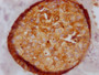 IHC image of RAC07302 diluted at 1:100 and staining in paraffin-embedded human breast cancer performed on a Leica BondTM system. After dewaxing and hydration, antigen retrieval was mediated by high pressure in a citrate buffer (pH 6.0). Section was blocked with 10% normal goat serum 30min at RT. Then primary antibody (1% BSA) was incubated at 4? overnight. The primary is detected by a Goat anti-rabbit IgG polymer labeled by HRP and visualized using 0.05% DAB.